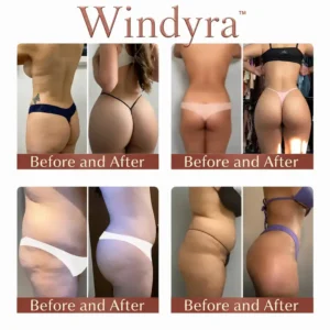Windyra™ CurveSculpt Micro-Patch