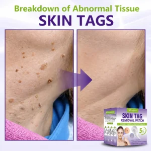 Windyra® Soluble Microneedle Botanical Skin Tag Removal Patch