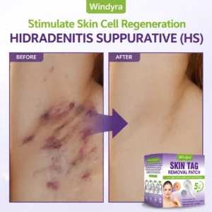 Windyra® Soluble Microneedle Botanical Skin Tag Removal Patch